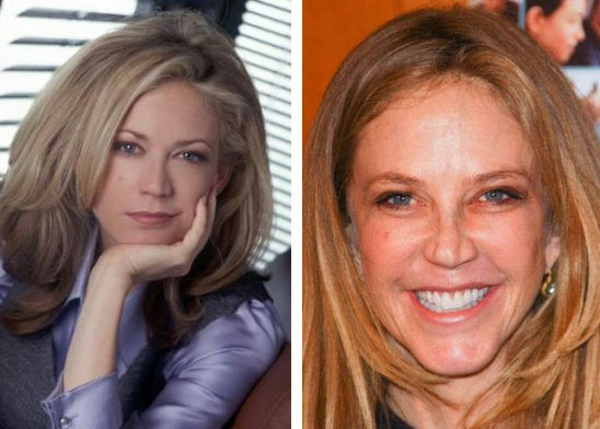 Ally Walker Before & After Plastic Surgery Ally Walker Before & After Plastic Surgery