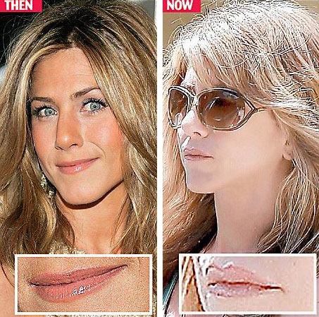Jennifer Aniston Lips Injection Before & After Jennifer Aniston Lips Injection Before & After