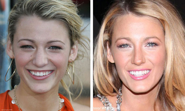Blake Lively Nose Job Blake Lively Nose Job