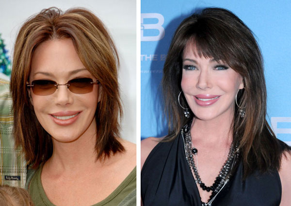 Hunter Tylo Before & After Plastic Surgery