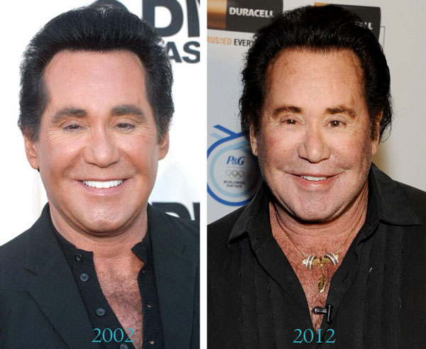 Wayne Newton Before & After Plastic Surgery Wayne Newton Before & After Plastic Surgery
