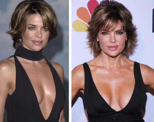 Lisa Rinna Breast Implants Before After Lisa Rinna Breast Implants Before After