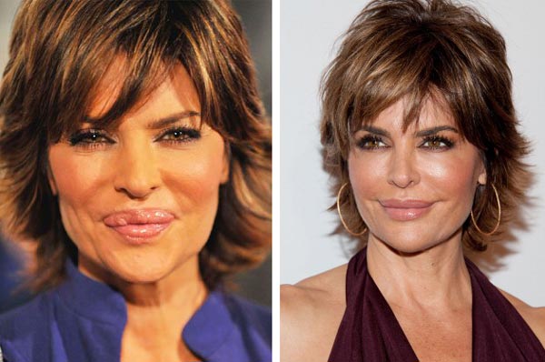 Lisa Rinna Lips Reduction Lisa Rinna Lips Reduction