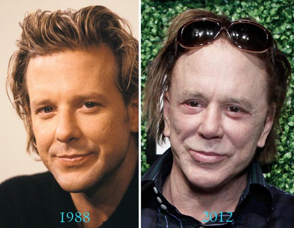 Mickey Rourke Before After Plastic Surgery Mickey Rourke Before After Plastic Surgery