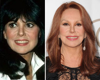 Marlo Thomas Plastic Surgery Marlo Thomas Plastic Surgery