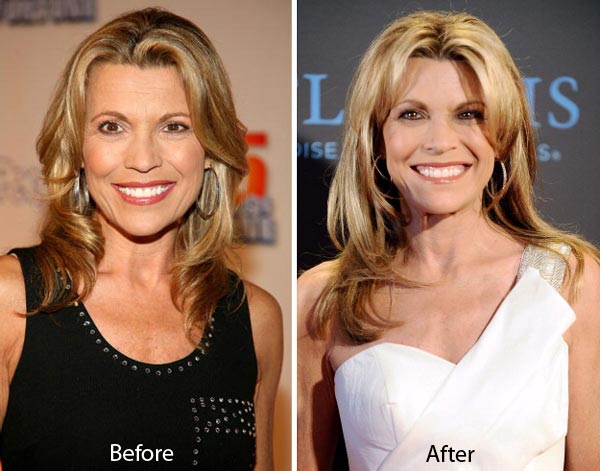 Vanna White Plastic Surgery Before After Vanna White Plastic Surgery Before After