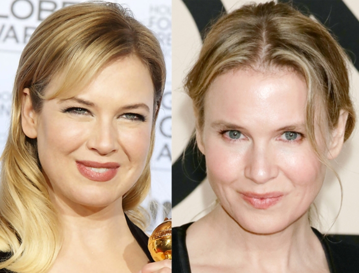 Renee Zellweger Plastic Surgery Before and After