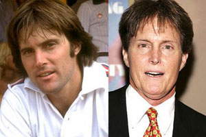 Bruce Jenner Plastic Surgery Before & After Photos