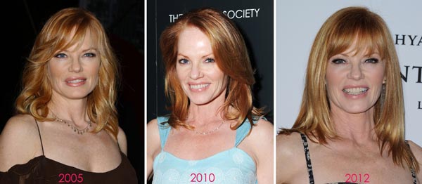 Marg Helgenberger Before & After Plastic Surgery