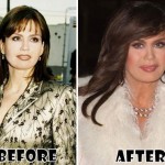 Marie Osmond Before & After Plastic Surgery