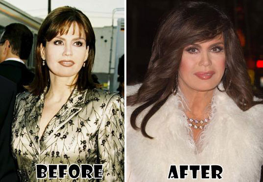 Marie Osmond Before & After Plastic Surgery