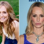 Taylor Armstrong Before & After Plastic Surgery