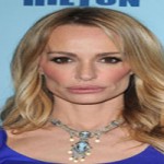 Taylor Armstrong Plastic Surgery
