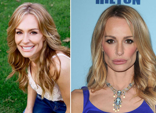 Taylor Armstrong Plastic Surgery