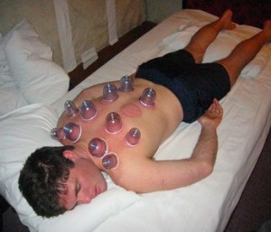 Cupping as Alternative Medicine