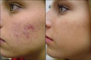 Remove the Scar Traditionally