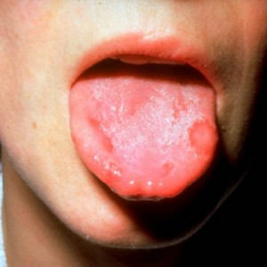 Traditional Treatment for Stomatitis